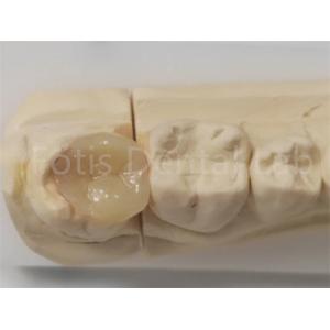 Aesthetic Inlay And Onlay In Dentistry For Indirect Filling And Tooth Restoration