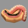 China Prótesis Acrílica Completa Sobre Implantes Dentales All On X AOX Clase 4 Con Anclaje Locator wholesale