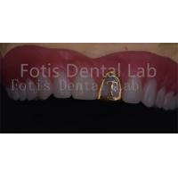 China OEM Natural Full Acrylic Denture Ivoclar Teeth Stain Resistance on sale