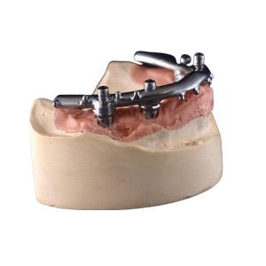 All-On-4 Titanium CNC Implant Secured Dentures For Dental Clinic