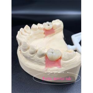 Customization Titanium/Ziconia/PFM Dental Lab Crowns Comfortable