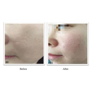 China 350mg 150mg PLLA Dermal Filler OEM Customization Injectable Plla For Long Lasting Results wholesale