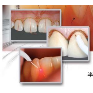 China Dental Tooth Whitening Machine dental laser teeth whitening supplier