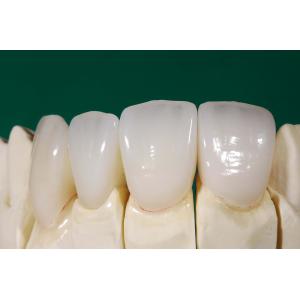 Dental IPS EMax Crown Professional Lithium Disilicate Crown China Dental Lab