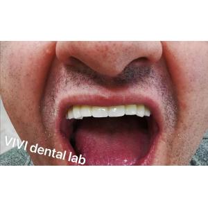 Dental Digital Full Zirconia Bridge In Mouth Professional Stable