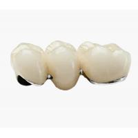 China Semi Precious Alloy Crowns PFM Restorations VIVI Dental Laboraotry on sale