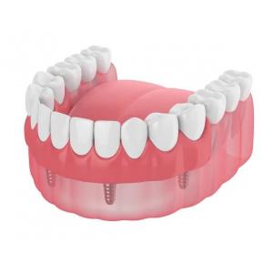 Dentures Missing Teeth Dental Implant Bar Fillings Dentures Temporary Removable Dentures