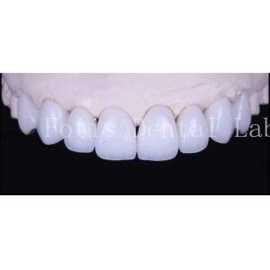 Adhesive Bonding Cement Natural White Veneers With High Translucency