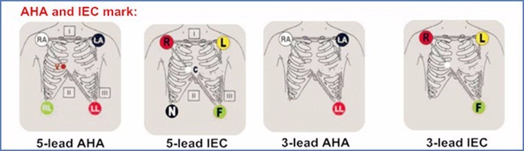 Disposable 5 Lead ECG Placement , ECG Lead Clips IEC / AHA Standard ...