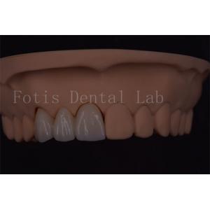ISO Certified Digital Dental Crowns For Tooth Implant Various Size