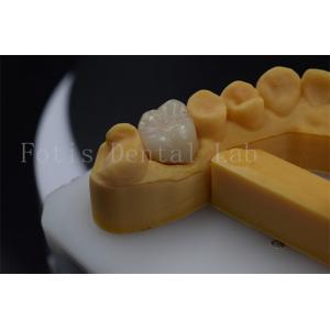 Titanium / PFM Denture Crown Customizable Zirconia Implant Crown Durable