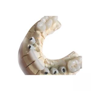 Metal Free White Zirconia Dental Crowns Excellent Biocompatibility