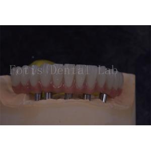 Customizable Dental Implant Crowns For Natural Looking And Comfortable Restorations