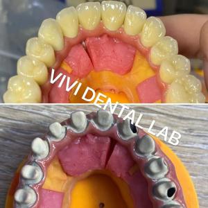 Ivoclar Digital Dental Crowns Process Noritake Porcelain High Accuracy