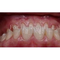 China 0.3-0.5mm Thickness Cosmetic Teeth Covers Veneers For Cosmetic Dentistry on sale