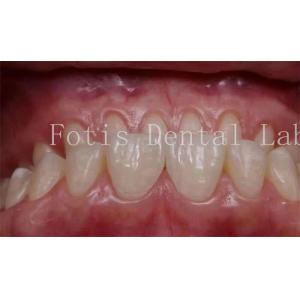 0.3-0.5mm Thickness Cosmetic Teeth Covers Veneers For Cosmetic Dentistry