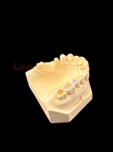 Natural Looking E.MAX Inlay Onlay Lithium Disilicate Inlay Onlay